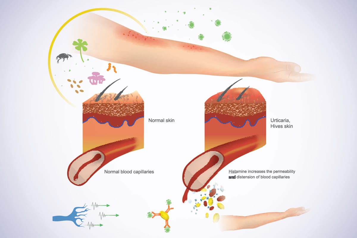 Increases-Histamine-Production